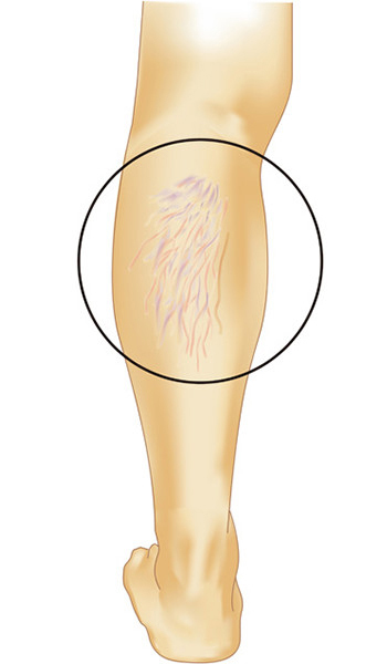 クモの巣状静脈瘤