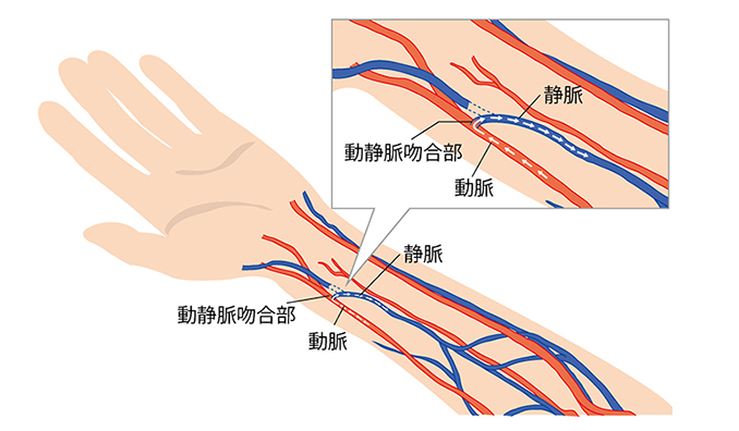 シャント